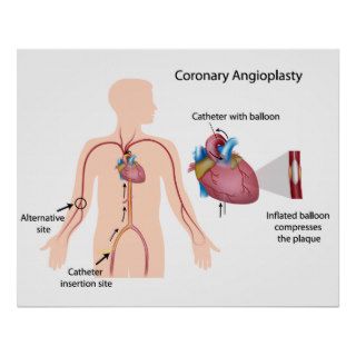 Coronary angioplasty Poster