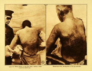 1920 Rotogravure WWI Mustard Gas Skin Burns Chemical Warfare Army William Mook   Original Rotogravure   Prints