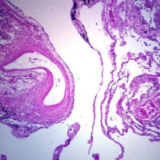 Human Anthracosis of Lung, sec. 7 µm H&E Microscope Slide