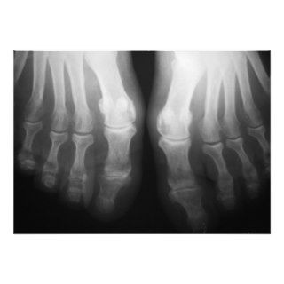 X Ray Feet Human Skeleton Bones Black & White Personalized Announcement