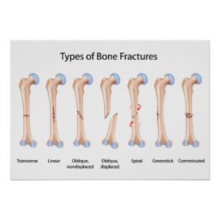 Types of bone fractures Poster